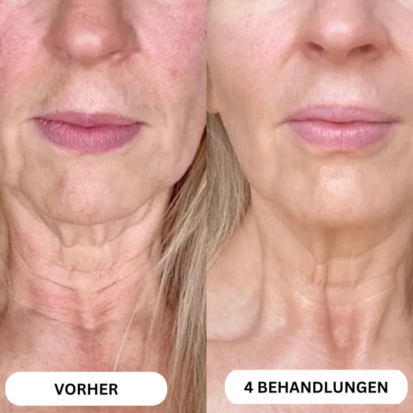 Natural Botulin 8-Wochen-Microinfusion-System™